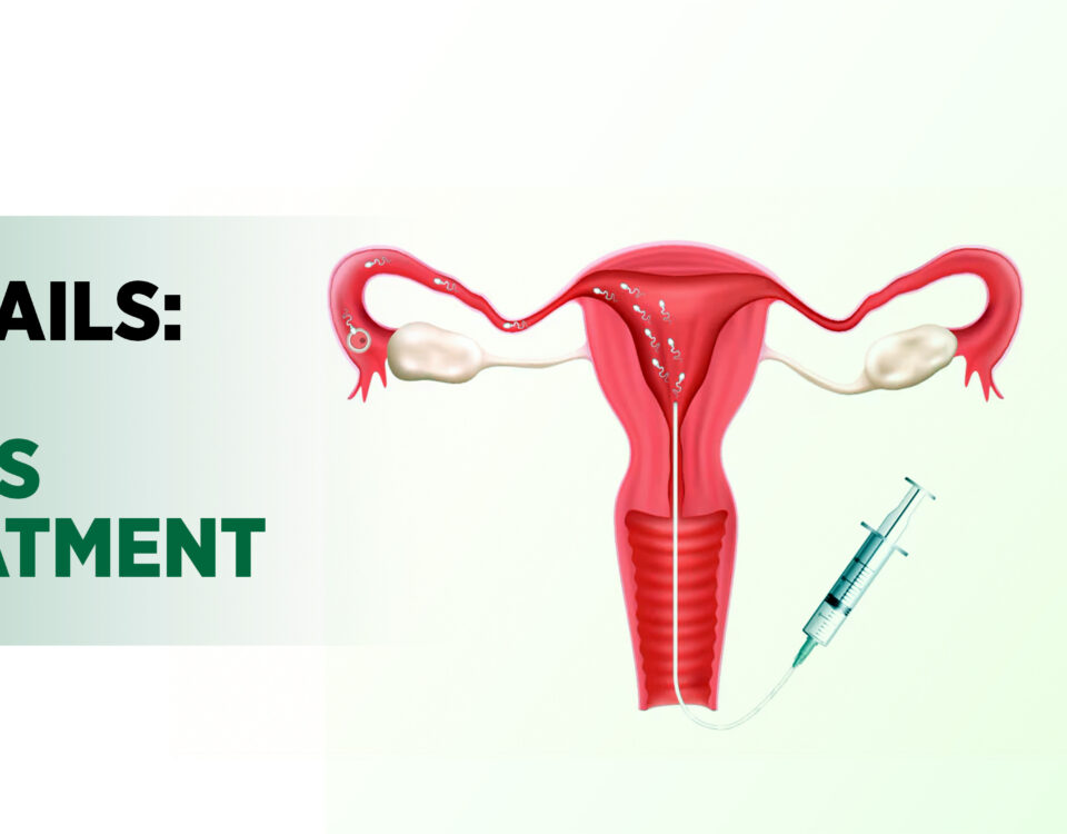 Reasons for IUI failures: causes,symtoms, and treatment